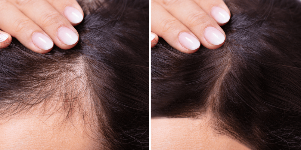 Benefits of Microneedling Hair Restoration with AnteAge Growth Factors